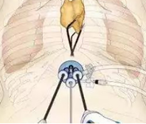 纵隔难治型肿瘤切除技术