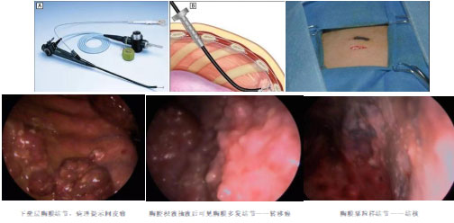 内科胸腔镜