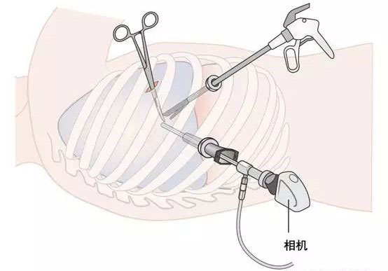 胸外科微创手术