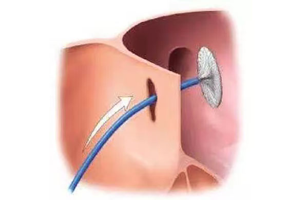 先天性心脏病的封堵术