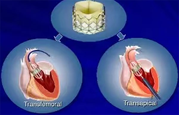 经导管主动脉瓣膜置入术