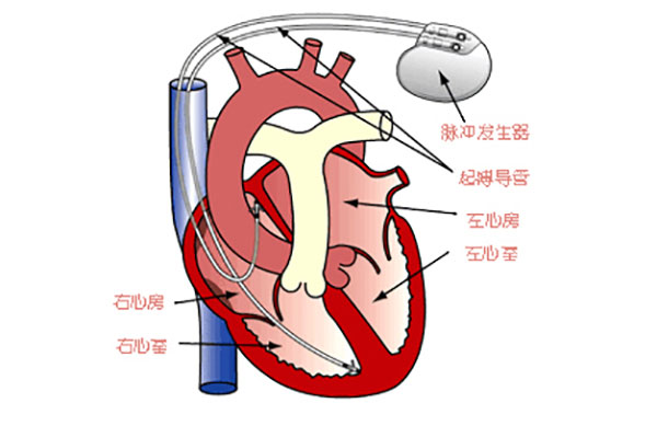 起搏器置入术