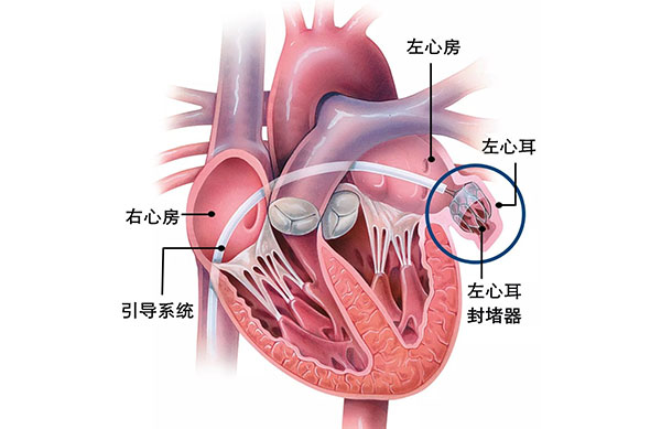 左心耳封堵术