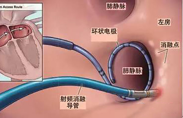 房颤及复杂心律失常的导管消融治疗