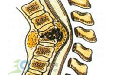 脊柱结核的诊治