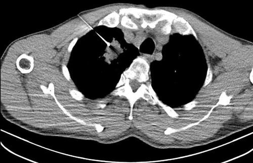CT引导下胸部病灶穿刺活检术
