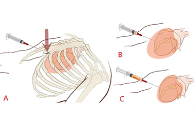 心包穿刺详细步骤图片