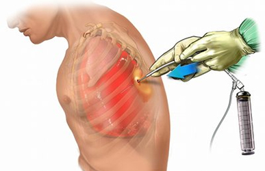胸腔穿刺术