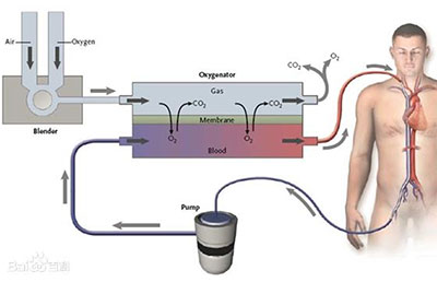 ECMO