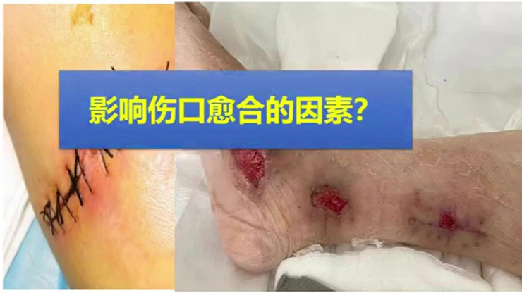 护理健康科普视频—影响伤口愈合的因素