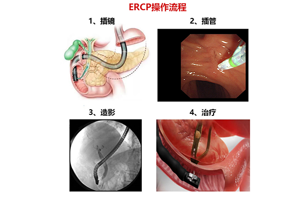 ERCP特色技术简介