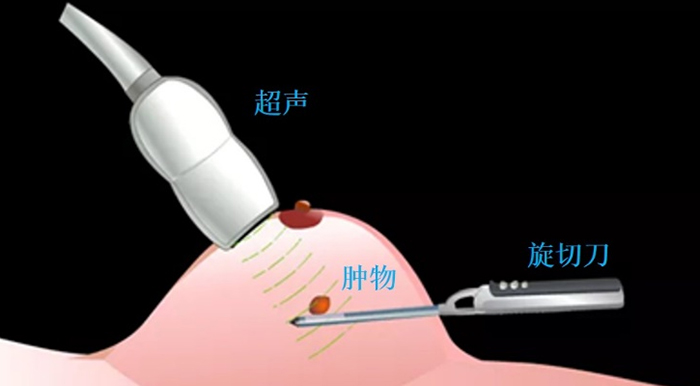 毫米解忧,守护女性健康与美丽——乳腺微创旋切术为乳腺结节患者带来新选择