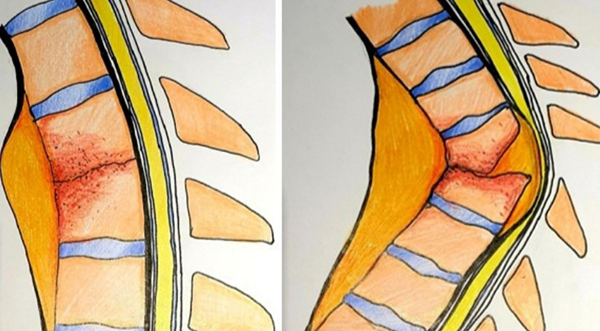 【世界防治结核病日】骨头里的“幽灵”脊柱结核，一个被忽视的致瘫元凶